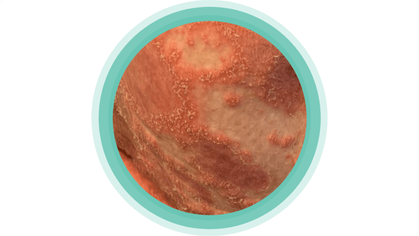 zaostrzenia, czynniki wyzwalające, rozległe krosty, leczenie UŁK, Act4GPP